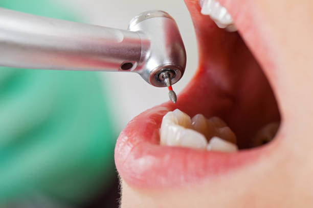 Best Emergency Dentist for Lost Fillings or Crowns in Taunton, MA